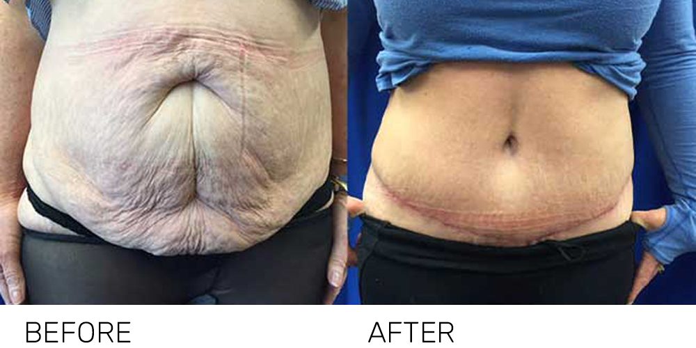 abdo-header Tummy Tuck Brisbane