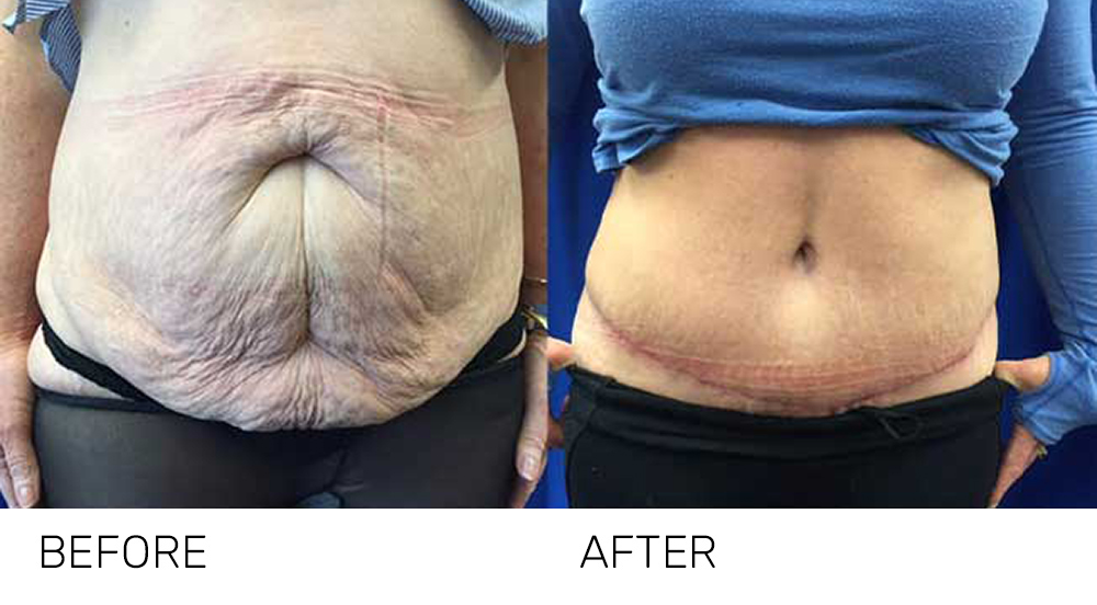 abdo-header Tummy Tuck Brisbane