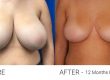 Breast Reduction Medicare Rebate