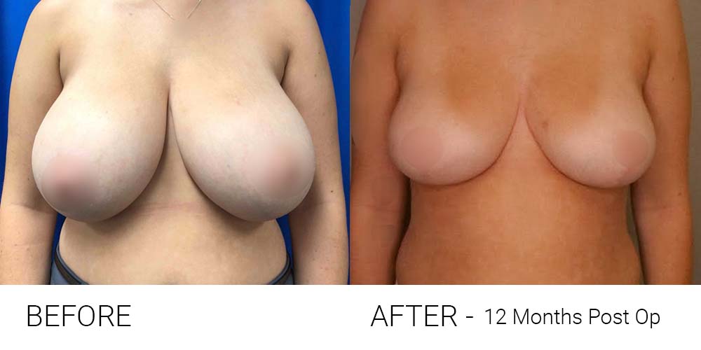 2021-07-Breast-Reduct Breast Reduction Medicare Rebate