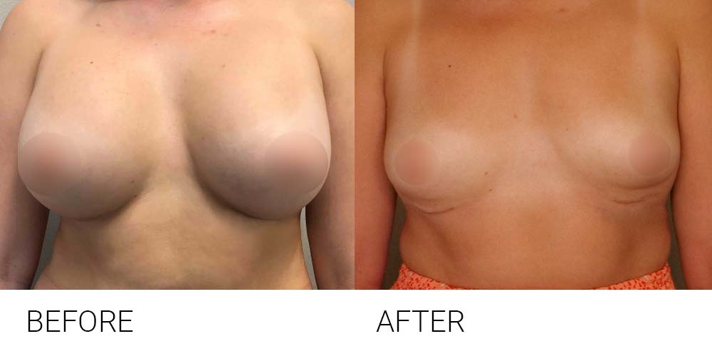 2021-07-implant-removal Breast implant removal covered by Medicare Australia