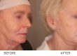 Facelift Recovery