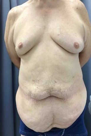 Abdominoplasty Before