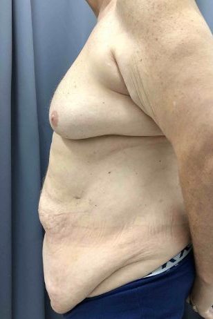 Abdominoplasty Before