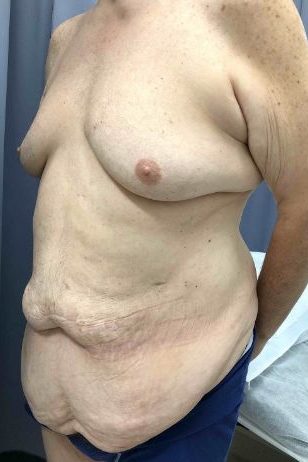 Abdominoplasty Before