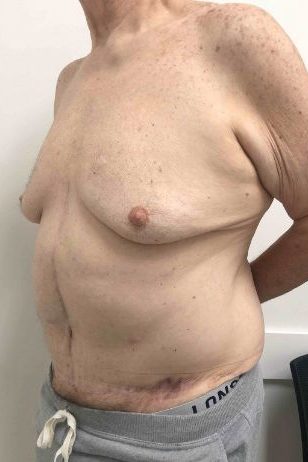 Abdominoplasty