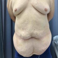 Tummy Tuck (Abdominoplasty) Brisbane - Dr Samuel Yang