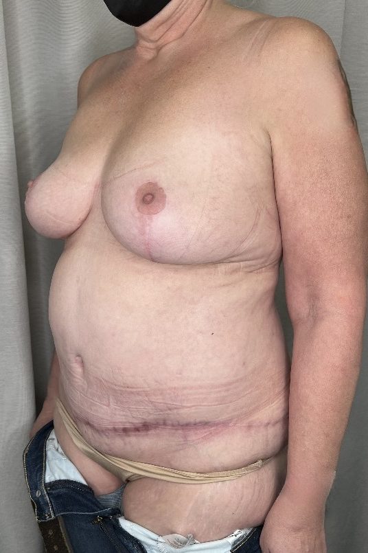 Abdominoplasty & Mastopexy