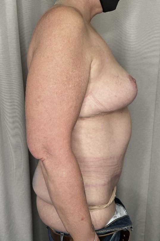 Abdominoplasty & Mastopexy