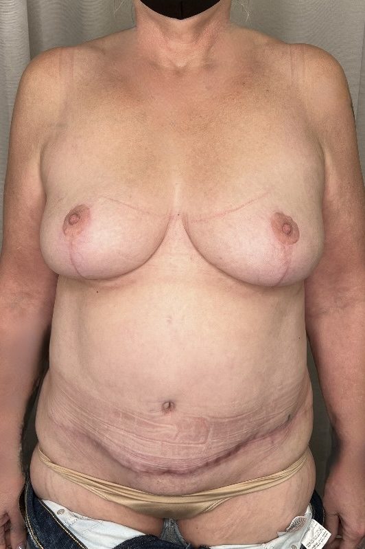Abdominoplasty & Mastopexy