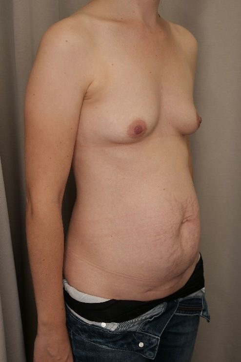Abdominoplasty & Breast Augmentation Before