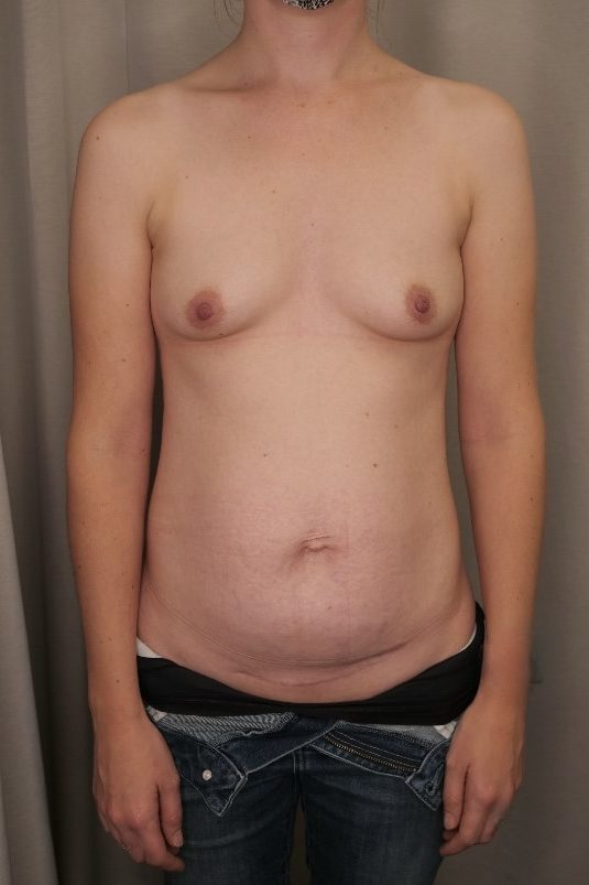 Abdominoplasty & Breast Augmentation Before