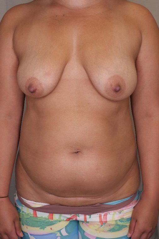 Abdominoplasty & Mastopexy
