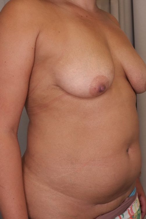 Abdominoplasty & Mastopexy Before