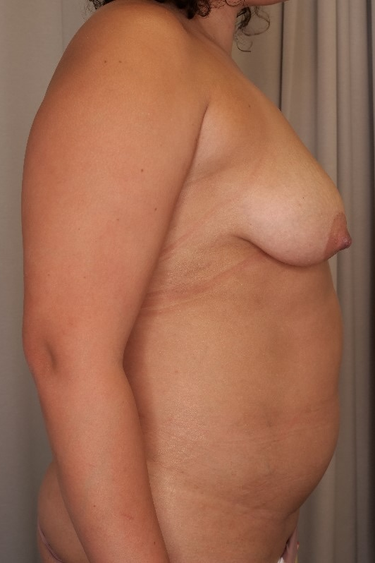 Abdominoplasty & Mastopexy Before