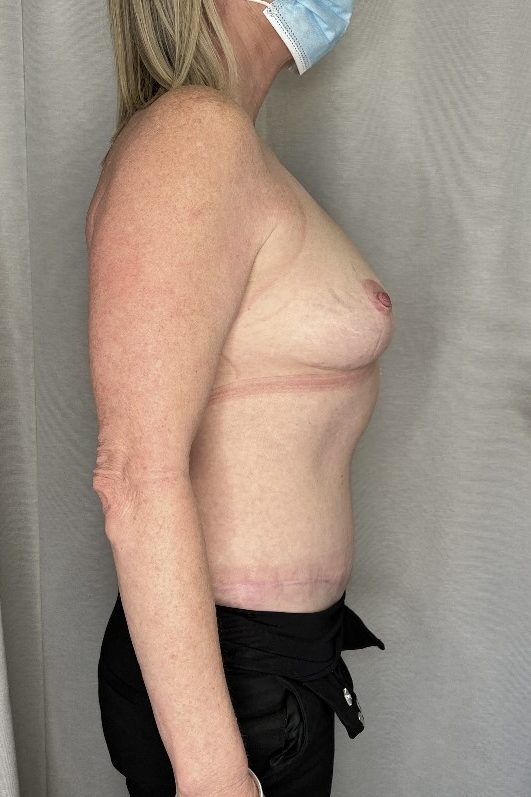 Abdominoplasty and Breast Reduction