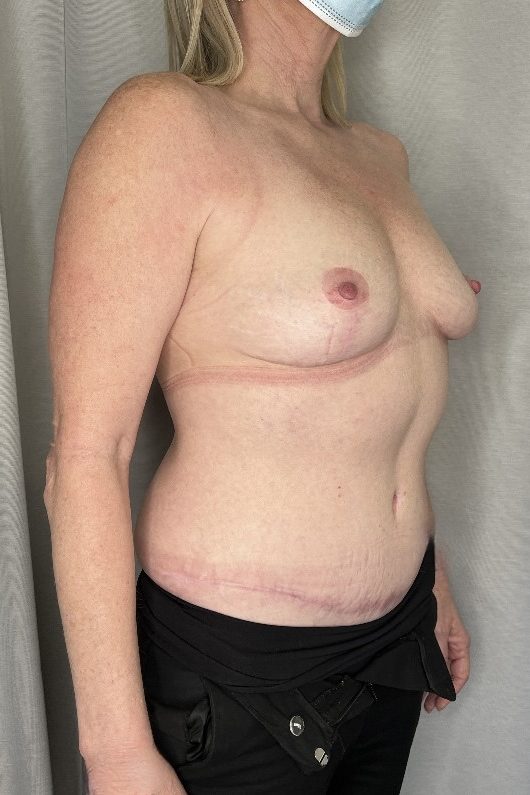 Abdominoplasty and Breast Reduction
