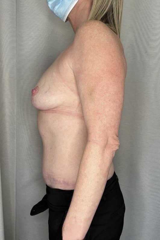 Abdominoplasty and Breast Reduction