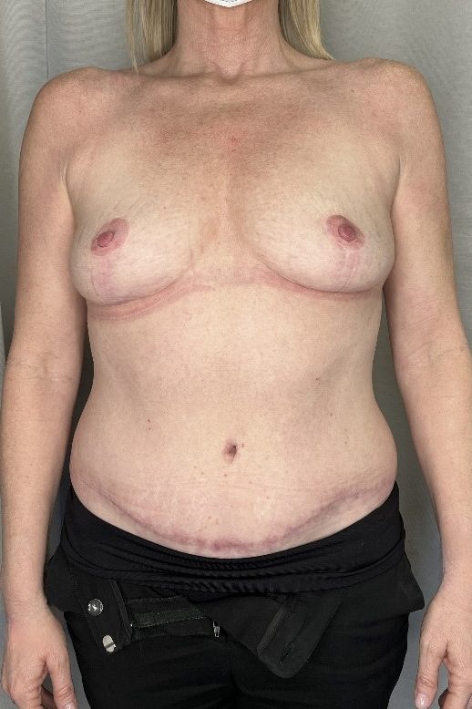 Abdominoplasty and Breast Reduction