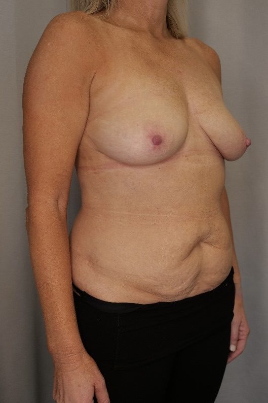 Abdominoplasty and Breast Reduction Before