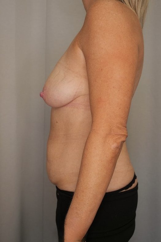 Abdominoplasty and Breast Reduction Before