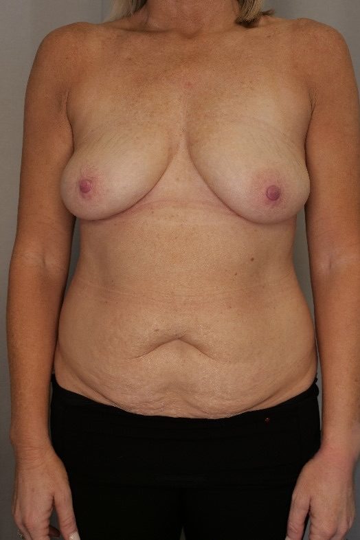 Abdominoplasty and Breast Reduction Before