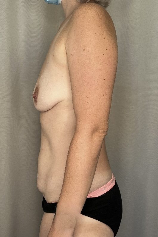 Abdominoplasty and Augmentation Mastopexy Before