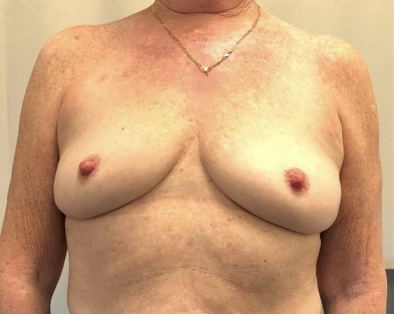Breast Augmentation Before