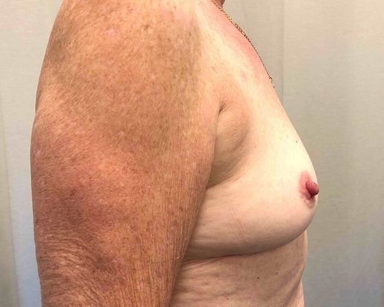Breast Augmentation Before