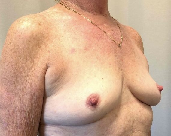 Breast Augmentation Before