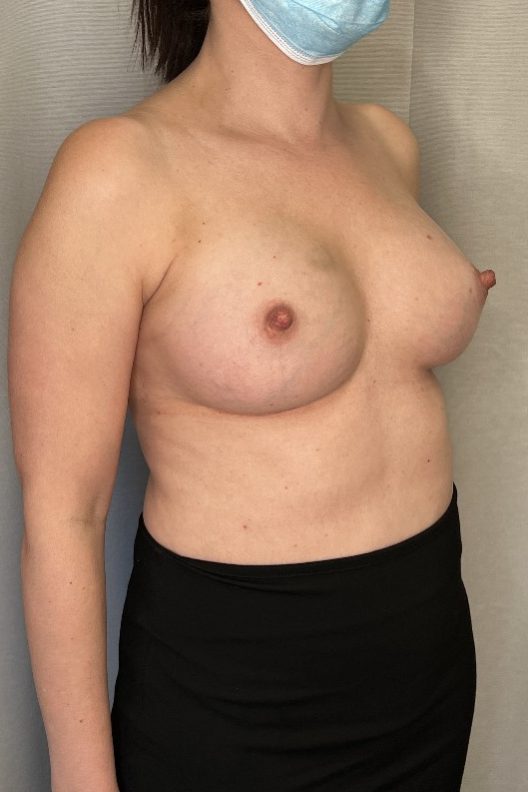 Breast Augmentation