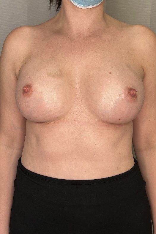 Breast Augmentation