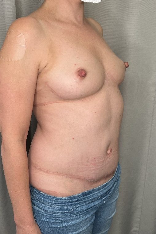 Breast Augmentation Before