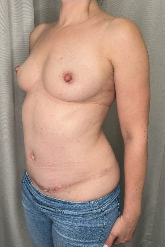 Breast Augmentation Before