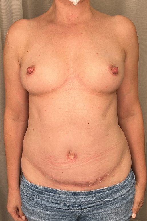 Breast Augmentation Before