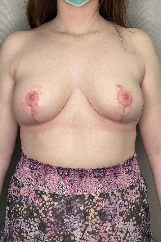 Breast Implant Removal & Breast Reduction