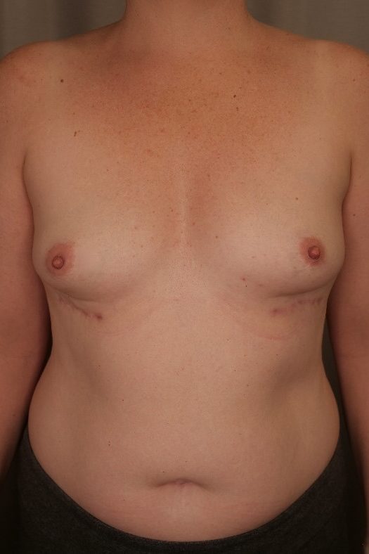 Breast Implant Removal