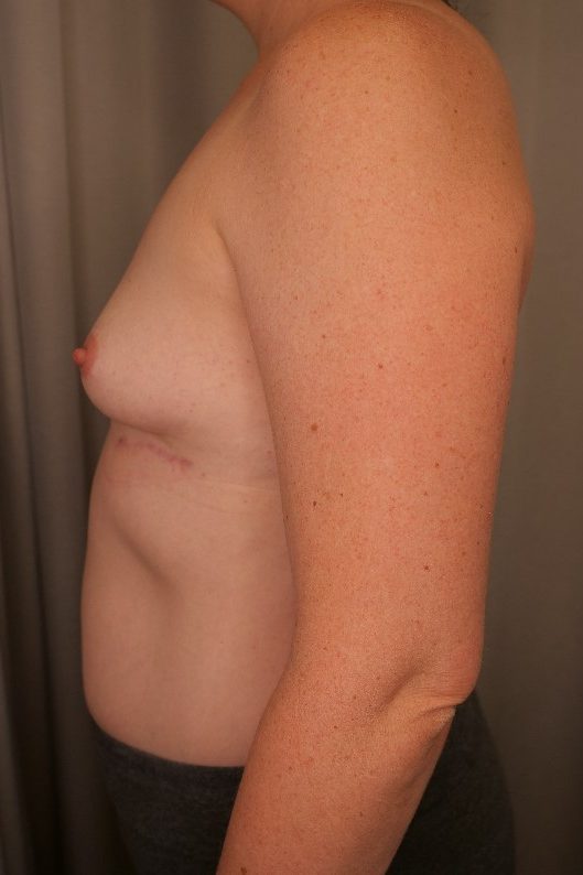 Breast Implant Removal