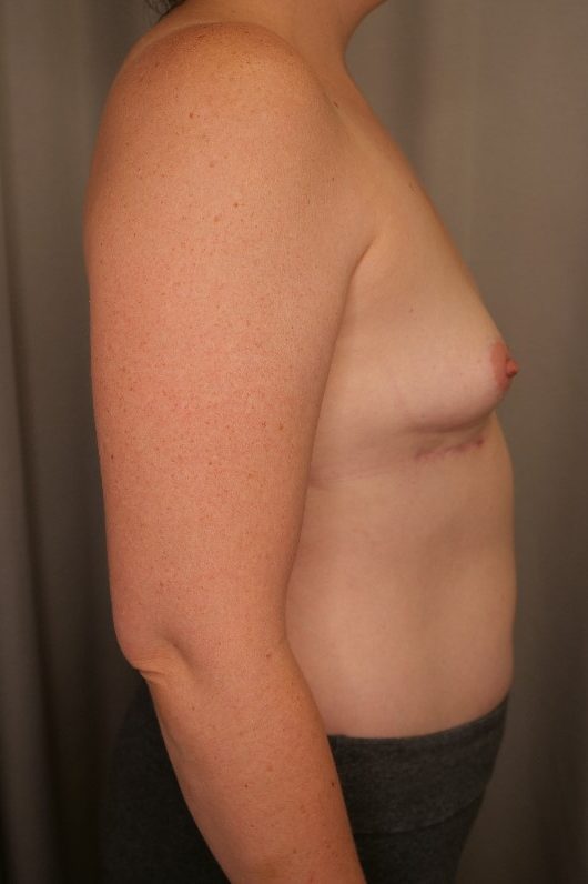 Breast Implant Removal