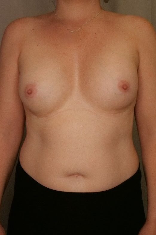 Breast Implant Removal Before