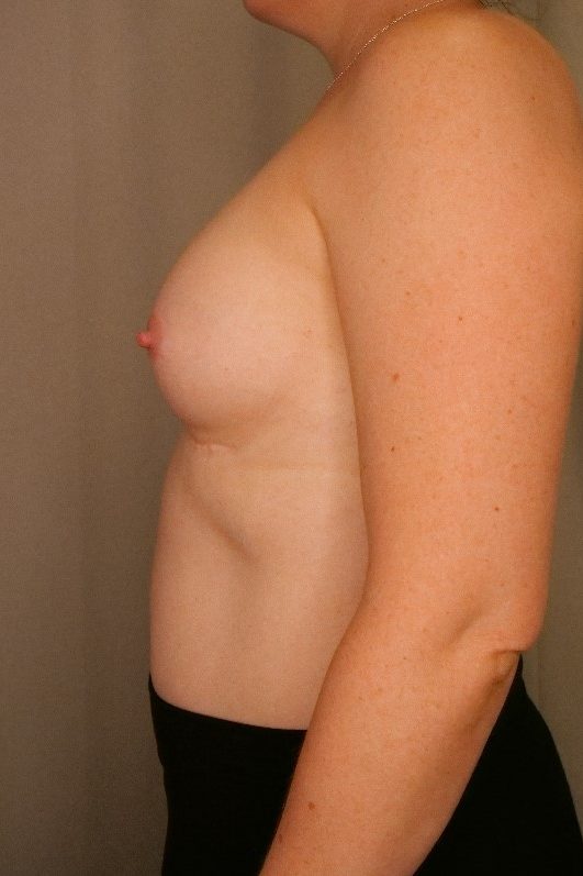 Breast Implant Removal Before