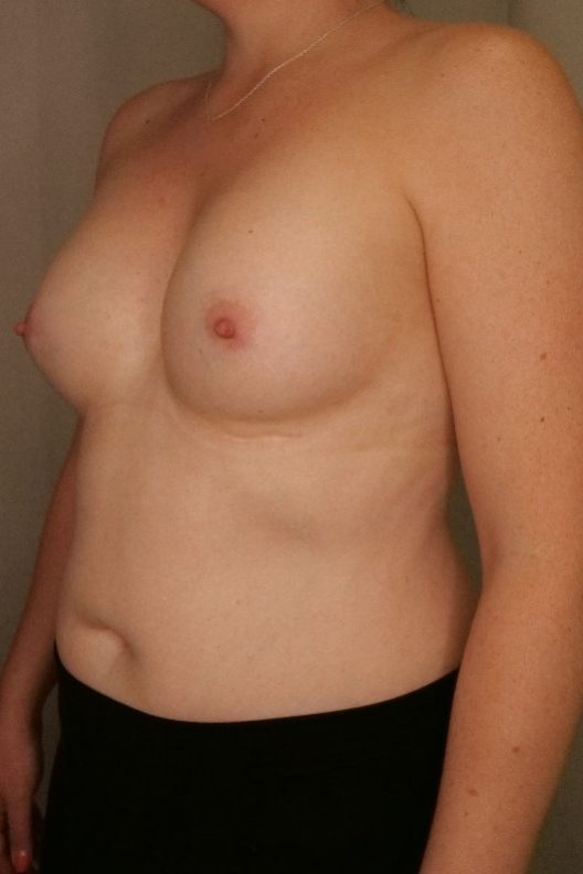 Breast Implant Removal Before