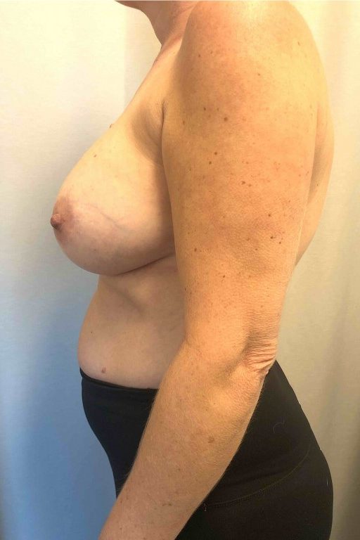 Breast Implant Removal & Replacement