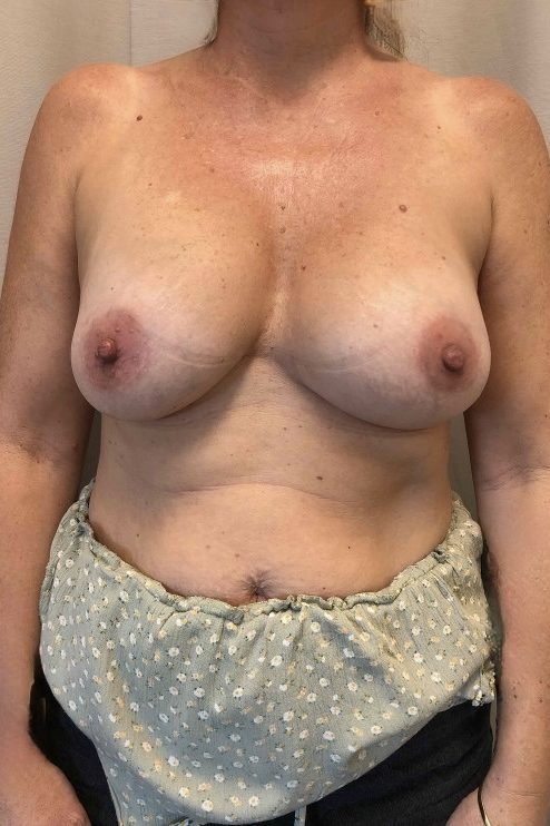 Breast Implant Removal & Replacement