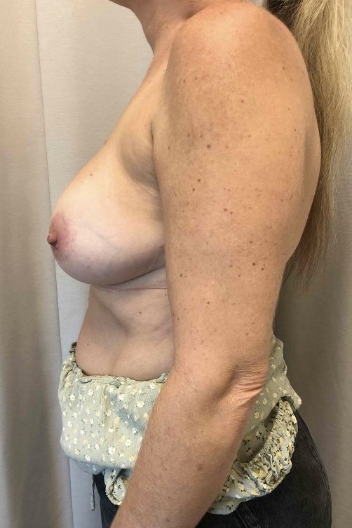 Breast Implant Removal & Replacement
