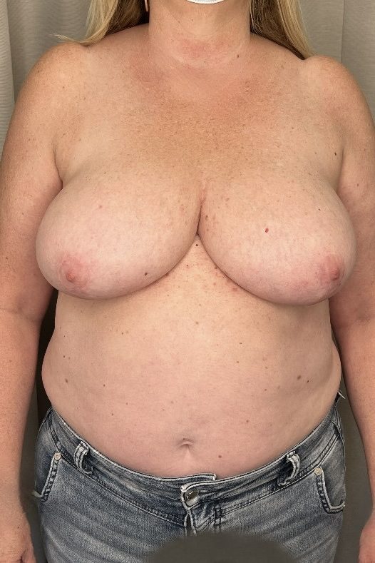 Breast Reduction