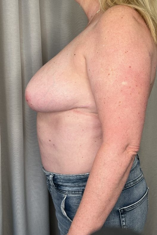 Breast Reduction