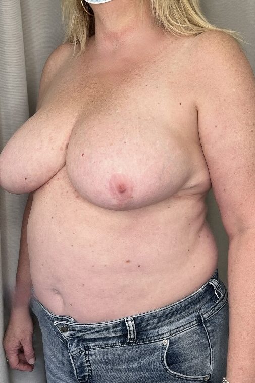 Breast Reduction