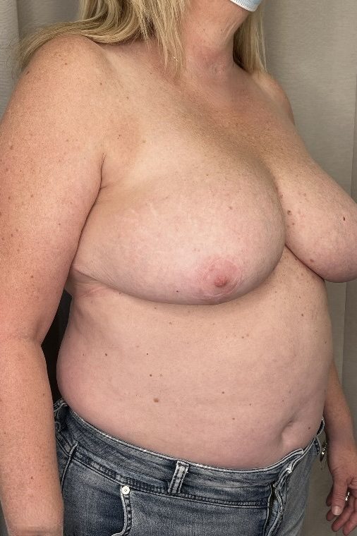 Breast Reduction
