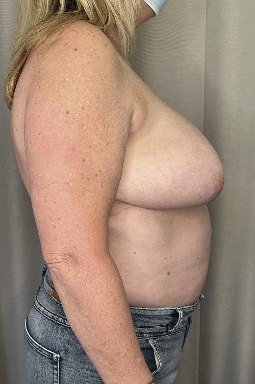 Breast Reduction